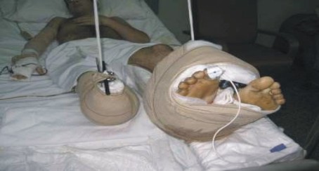 Sanidad autoriza el primer trasplante de piernas doble del mundo