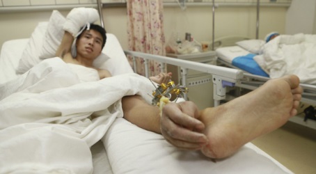 Cirujanos injertan en tobillo la mano amputada de un paciente para mantenerla con vida